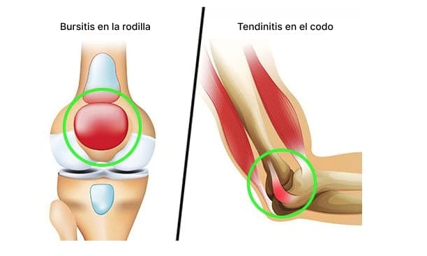 Inflammation can lead to permanent joint injury.